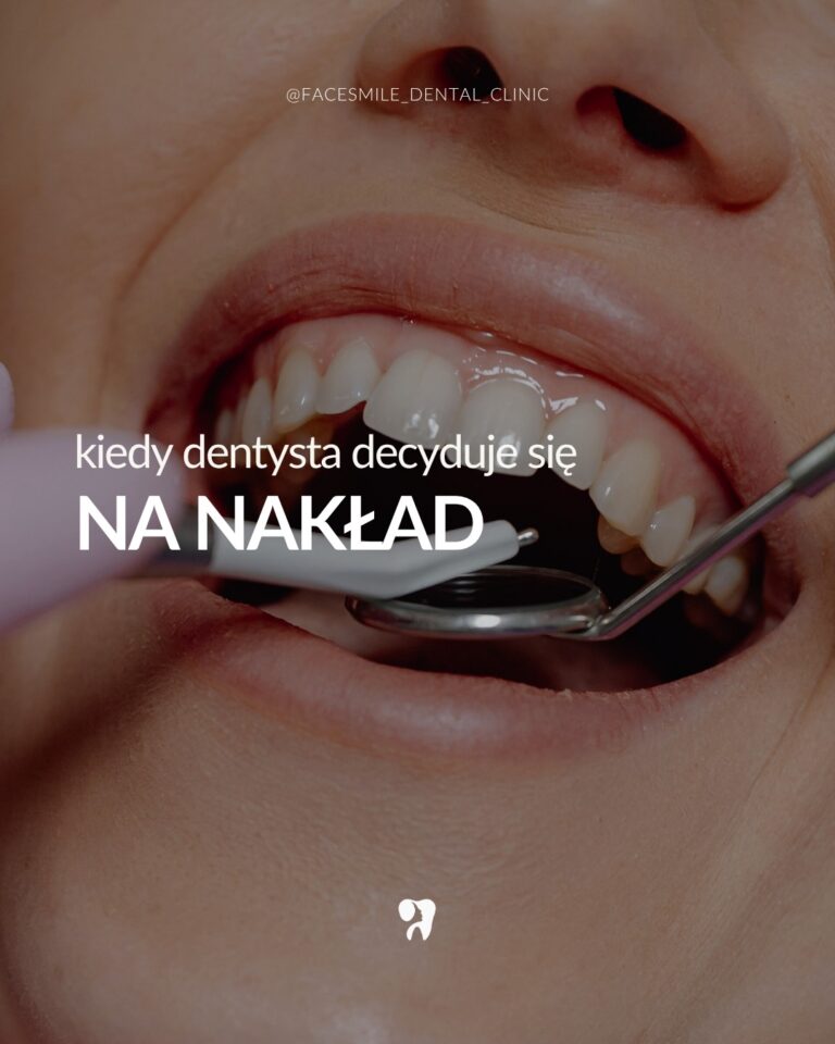 Face Dental Onlay Inlay