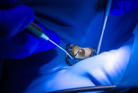Koferdam - Face Smile Dental Clinic